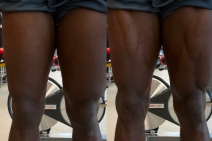 重伤归来！阿方索晒照自己腿部的变化，轻松练出肌肉